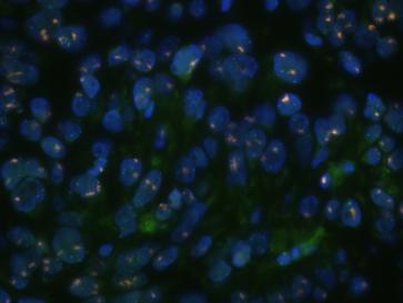 Abb. 8. High-grade-Angiosarkom. Amplifikation des MYC Gens (rote „Signalwolken“ mit der MYC-DANN-Sonde, Gen- locus 8q34) in der Fluoreszenz In-Situ-Hybridisierung (FISH) Untersuchung.