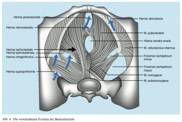 Abb. 4. Die verschiedenen Formen der Beckenhernien