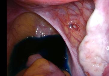 Abb. 1a. Diskrete Eindellung mit Endometrioseherd