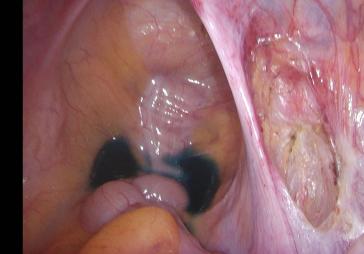 Abb. 1b. Nach Excision des Peritonäums