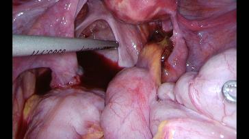 Abb. 2a. Pat. mit chron Unterbauchschmerzen rechts, die nach OP verschwinden