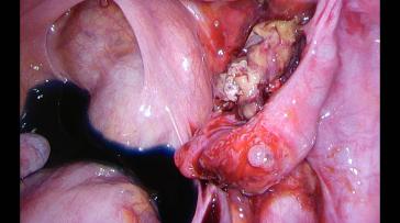 Abb. 2b. Verwachsenes Ovar und Tube mit rel. viel Fibrinbil- dung
