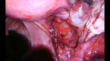 Abb. 2c. Nach Adhäsiolyse rel. tiefe, beginnende Ischiashernie.
