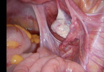 Abb. 3a. Deutliche Eindellung ohne Adhäsionen oder Endome- triose (keine Beschwerden).