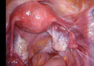 Abb. 3b. Nach Tabaksbeutelnaht des Peritonäums liegt das Ovar „frei“ an der Beckenwand.