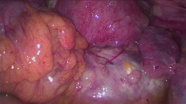 Abb. 3. Endometriose Assoziiertes Ovarialkarzinom (hellzelliges Ovarialkarzinom)