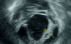 Der spezielle Fall - Der etwas andere „unklare Adnexbefund“: Schwannom des Nervus obturatorius