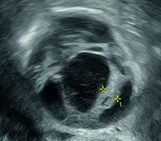 Abb. 1. Ultraschallbild des Befundes an der Beckenwand