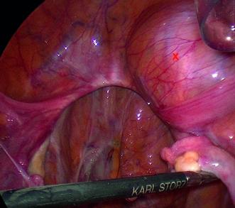 Abb. 2. Intraoperativer Befund (Tumor markiert mit einem X)
