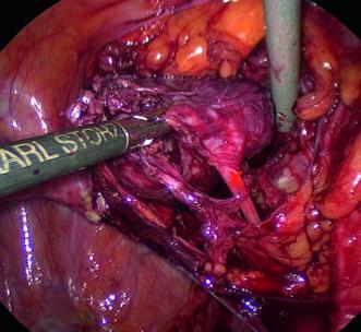 Abb. 3. Befund bei der Präparation (N. obturatorius markiert mit einem X)