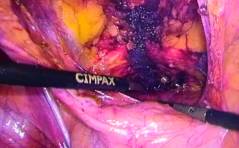 Forum - Implantatausbau nach Beckenbodenrekonstruktion: wann, wie, wieviel?