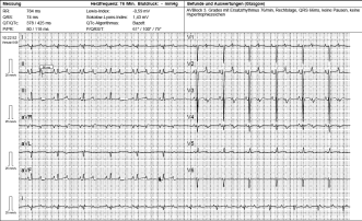 Abb. A. Neonatales EKG mit AV-Block 3. Grades und ventrikulärem Ersatzrhythmus mit einer Frequenz von 76/min.