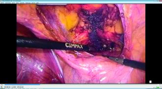 Abb. 2. Laparoskopische Resektion eines retropubischen Bandes bei Schmerzen. Das Cavum Retzii ist eröffnet, der linke Bandanteil (blau) gut erkennbar.