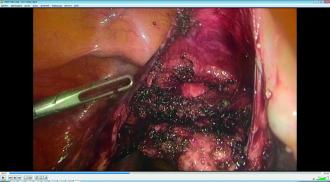 Abb. 1. Laparoskopisch partielle Resektion eines vorderen Vaginalnetzes bei Schmerzen. Die Blase ist nach distal mobilisiert, der Vaginalstumpf und der störende Netzteil sind freigelegt.