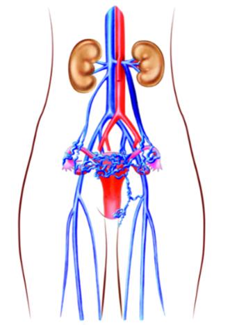 Abb. 1. Typ Ovarialvene – Krampfadern im Becken aufgrund von insuffizienter Ovarialvene