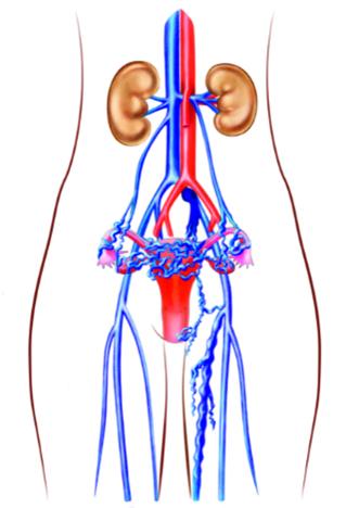 Abb. 2. Typ Innere Beckenvene – Krampfadern im Becken aufgrund insuffizienter innerer Beckenvene.