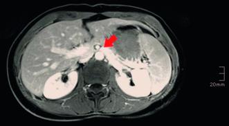 Abb. 4. Nutcracker-Syndrom; Komprimierung der V. renalis links durch die Aorta abdominalis und A. mesenterica superior.