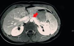 Forum - Pelvic Congestion Syndrom – chronische Unterbauchschmerzen bei Frauen aufgrund von Krampfadern im Beckenbereich