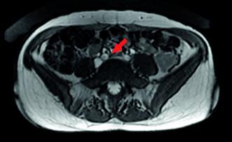 Abb. 5. May Thurner-Anomalie; Kompression der Vena iliaca durch die Arteria iliaca.