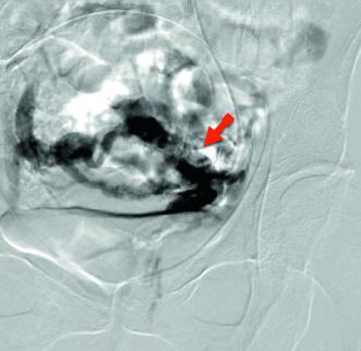Abb. 6. Parauterine Varizen.