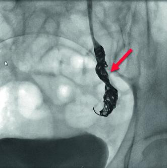 Abb. 7. Verschlossene Vena ovarica links nach erfolgreicher Implantation von sechs Metallspiralen (Coils) nach der ersten Katheterintervention.