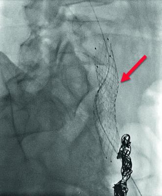 Abb. 8. Sanierung der May-Thurner-Anatomie mittels Stent-Implantation: wiedereröffnete Vena iliaca communis links nach der zweiten Katheterintervention.