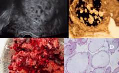 Forum - Gestational trophoblastic disease (GTD)