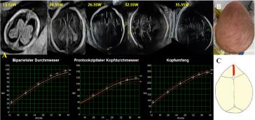 Abb. 1. (A) Biometrische und morphologische Entwicklung des Kopfes. In der 35. SSW erstmals Hinweise einer Trigonocephalie, welche postnatal (B) klar war. SchemaDsch (C) die vorzeiDg fusionierte Sutura frontalis als Ursache dieser  speziellen Kopfform.  