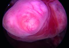 Myome – ein Update zu einem häufigen Krankheitsbild