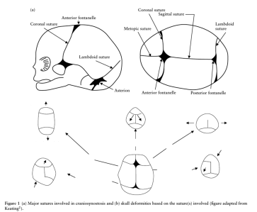 Grafik 1. Schädelformen nach betroffenen Synostosen (modifiziert aus [3]). Das Verhältnis zwischen dem biparietalen (BIP) und fronto-occipitalen Durchmesser (OFD) differenziert zwischen Dolicho- und Brachcephalie