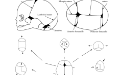 Sonoquiz Auflösung - Vorzeitiger Verschluss der Sutura frontalis mit Trigonocephalie