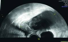 Der spezielle Fall - Ein unkonventioneller Adnexbefund