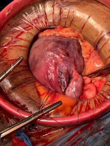 Abb. 4. Intraoperatives Bild bei Sectio caesarea: fehlende Tube links, ansonsten unauffälliger Situs