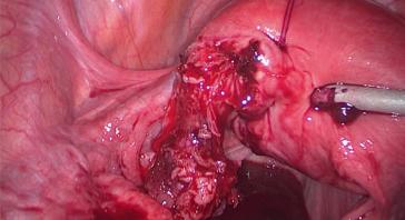 Abb. 1. Tabaksbeutelnaht ­proximal der linken Tube