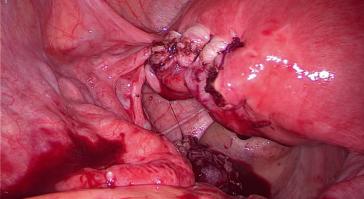 Abb. 2. Adaptation der Uteruswand mit einem Faden mit Widerhaken (V-loc 2.0)