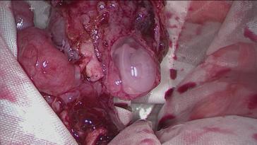 Abb. 3. Entfernung der linken Tube und des Schwangerschaftsproduktes im Bergebeutel