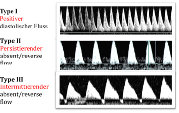 Abb. 3. Klassifizierung von MC Zwillingen mit sIUWR anhand der Dopplerflussqualitäten der Nabelschnurarterie des kleine-ren Feten (Einteilung nach Gratacos).