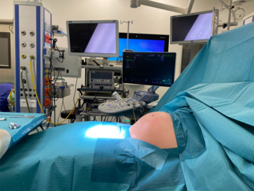 Abb. 4. Typischer OP-Ansicht und Ausstattung bei fetoskopischem Eingriff. Hier eine Patientin mit schwerem FFTS in der 22.SSW. Bauch klinisch wie 32 Wochen bedingt durch ein massives Polyhydramnion