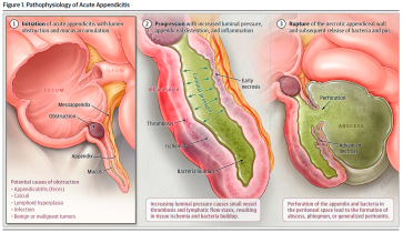 Abb. 1. Pathophysiologie einer akuten Appendizitis