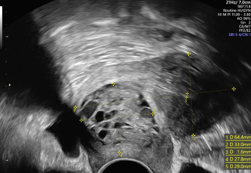 Abb. 1. Sonographisches Bild bei der Erstkonsultation.