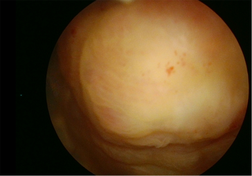 Abb. 2. Hysteroskopisches Bild: glatt begrenzter Polyp.