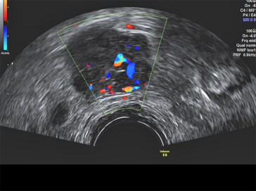 Abb. 1. Suspekter, hypervaskularisierter Befund in der rechten Adnexloge. Die Nähe zu den Beckengefässen ist auffällig. Es handelt sich um eine Patientin mit einer vorbekannten Lymphangioleiomyomatose, die sich auch im Becken manifestiert. Es handelt sich also um einen vergrösserten Lymphknoten im Externa-Stromgebiet. Der Befund wird regelmässig verlaufskon-trolliert.