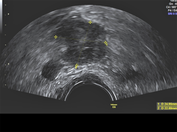Abb. 1. Suspekter, hypervaskularisierter Befund in der rechten Adnexloge. Die Nähe zu den Beckengefässen ist auffällig. Es handelt sich um eine Patientin mit einer vorbekannten Lymphangioleiomyomatose, die sich auch im Becken manifestiert. Es handelt sich also um einen vergrösserten Lymphknoten im Externa-Stromgebiet. Der Befund wird regelmässig verlaufskon-trolliert.