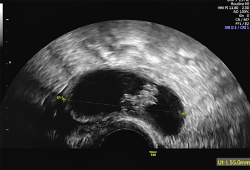 Abb. 2. Suspekter, zystisch solider Adnexbefund mit papillären Binnenstrukturen bei einer postmenopausalen Frau. Diag-nose nach beidseitiger Adnexektomie im Bergebeutel: Zystadenofibrom