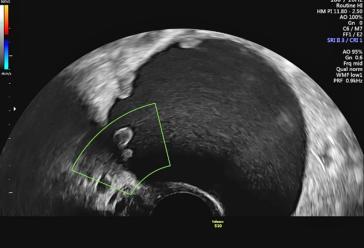 Abb. 2. Suspekter, zystisch solider Adnexbefund mit papillären Binnenstrukturen bei einer postmenopausalen Frau. Diag-nose nach beidseitiger Adnexektomie im Bergebeutel: Zystadenofibrom