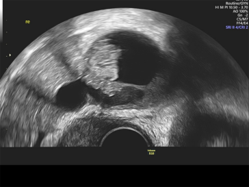 Abb. 3. Suspekter, zystisch solider Adnexbefund bei einer 39-jährigen Patientin. Diagnose nach einseitiger Adnexektomie im Bergebeutel: seröser Borderline Tumor des Ovars.