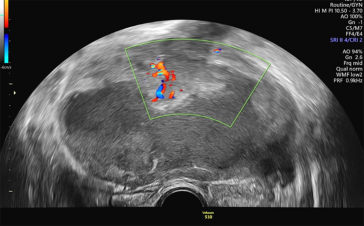 Abb. 4. Suspekter, das gesamte Becken ausfüllender zystisch solider Adnexbefund bei einer prämenopausalen Patientin. Überraschende intraoperative Diagnose während der explorativen Längslaparotomie: gastrointestinaler Stromatumor (GIST) des Dünndarms.