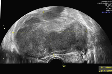 Abb. 4. Suspekter, das gesamte Becken ausfüllender zystisch solider Adnexbefund bei einer prämenopausalen Patientin. Überraschende intraoperative Diagnose während der explorativen Längslaparotomie: gastrointestinaler Stromatumor (GIST) des Dünndarms.