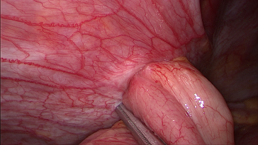 Abb. 1. Hernierung einer Dünndarmschlinge durch einen 5-mm-Trokar-Zugang