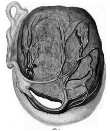 Abb. 1. Kopie aus der Publikation von Schmidt (aus Ref. 3) mit Darstellung der Rupturstelle im Bereiche des unteren Plazen-tarandes.